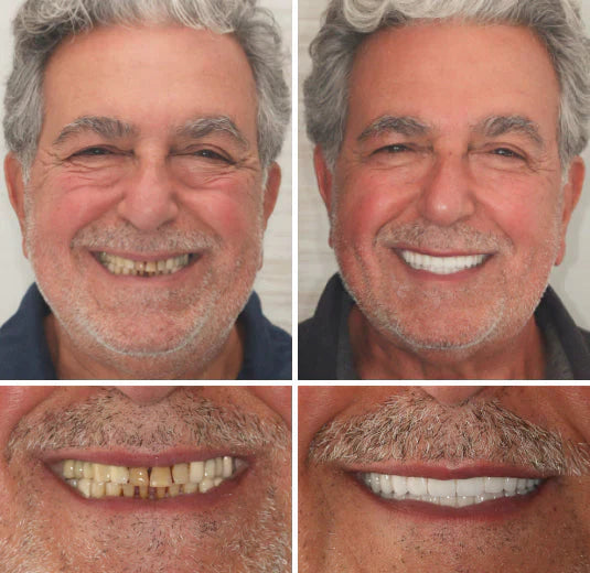 ✅ Made and Shipped from the US|Yagoo™ Suction-fit Complete Denture 🍀