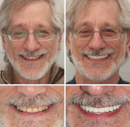 ✅ Made and Shipped from the US|Yagoo™ Suction-fit Complete Denture 🍀