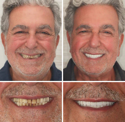 ✅ Made and Shipped from the US|Yagoo™ Suction-fit Complete Denture 🍀